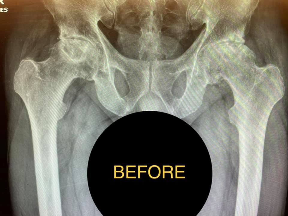 HIps x-ray Before