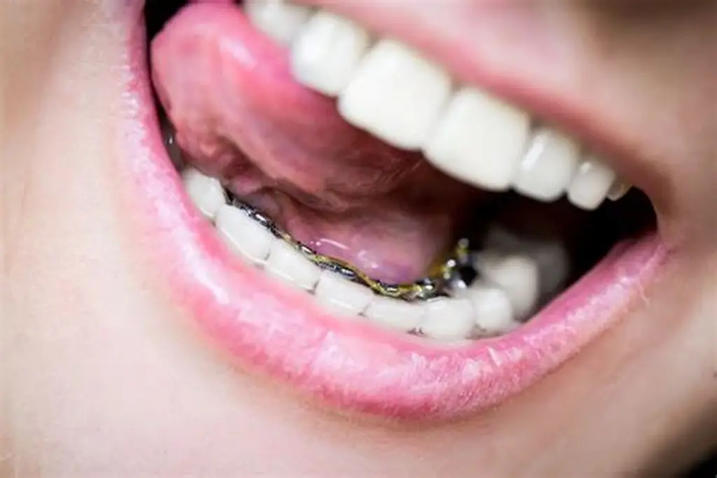 Lingual Braces Orthodontic Treatment