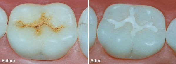 Pit & Fissure Sealants