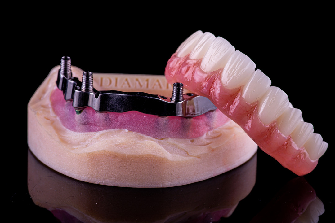 Hybrid Dentures
