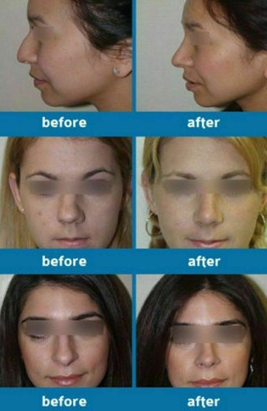Lève-nez En Silicone - Redresseur De Nez Sans Chirurgie - Forme U Confortable - Pour Usage Quotidien - 4.5 X 1.5 X 5 Cm