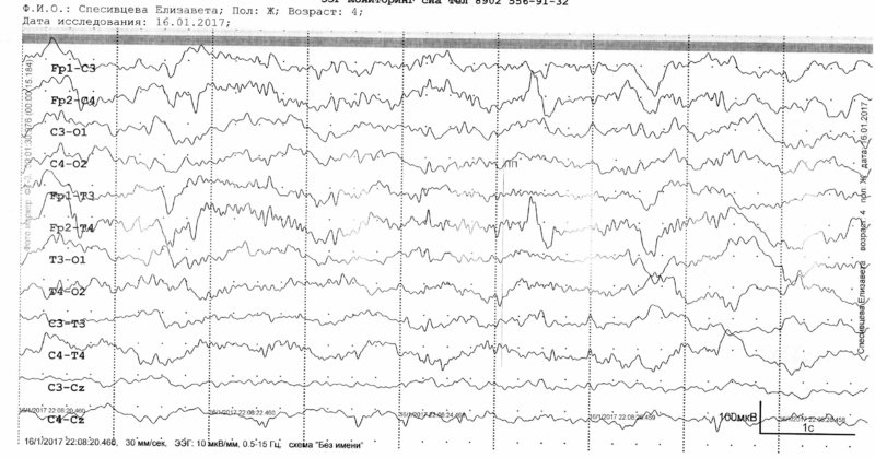 ЭЭГ04