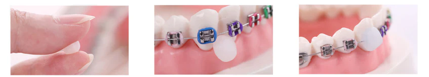 Как использовать воск для брекетов