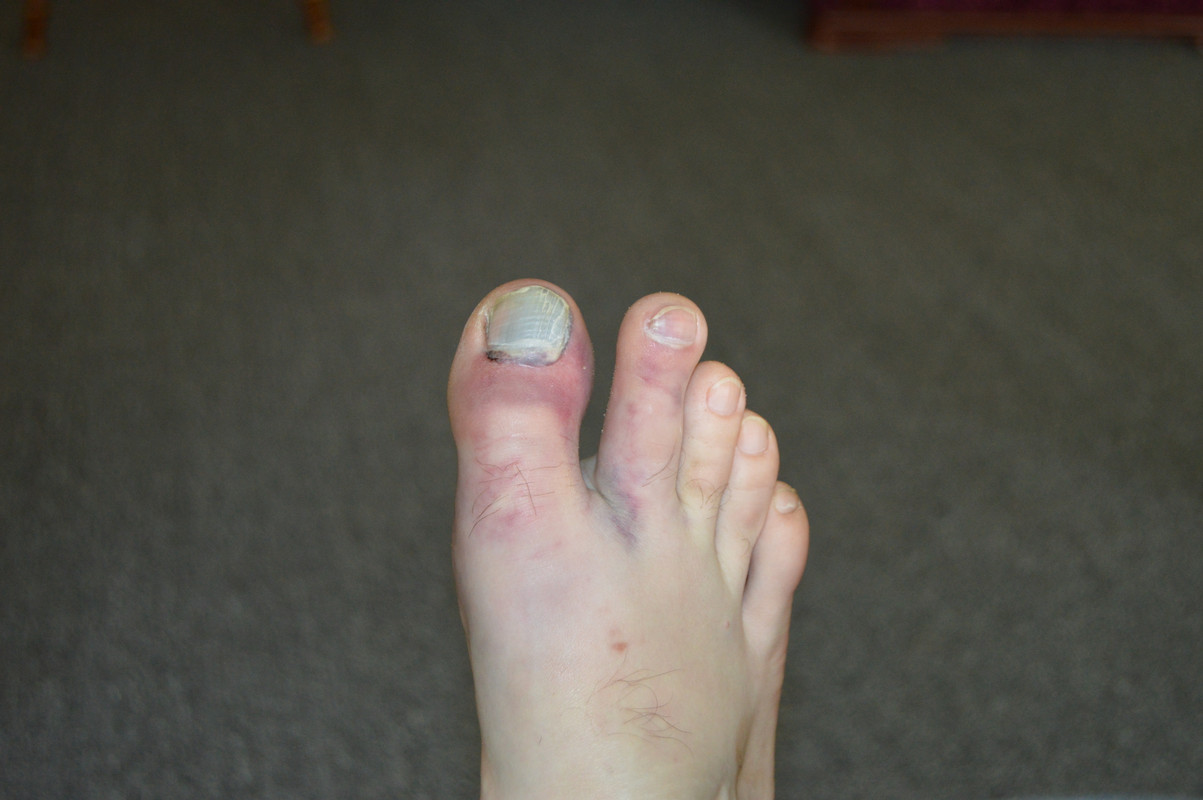 broke toes 001