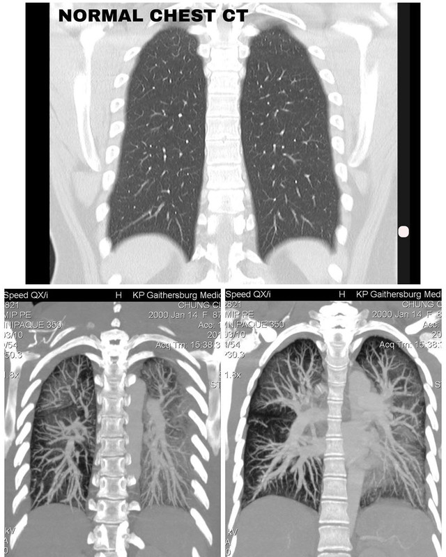 Potret hasil CT scan paru-paru Claire Chung