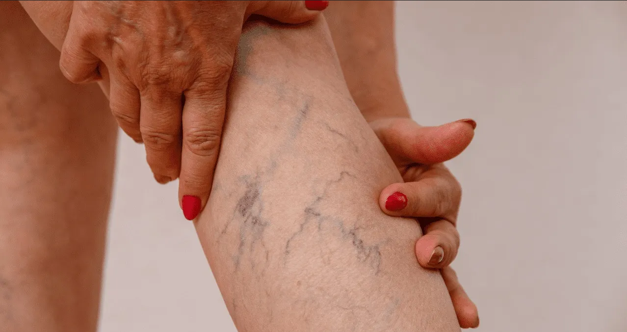 ¿Cuándo ir al médico por varices? Estas son las señales de alerta