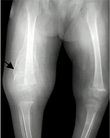 X-ray long bones showing classic findings of scurvy – Frankel line, Trummerfeld zone
