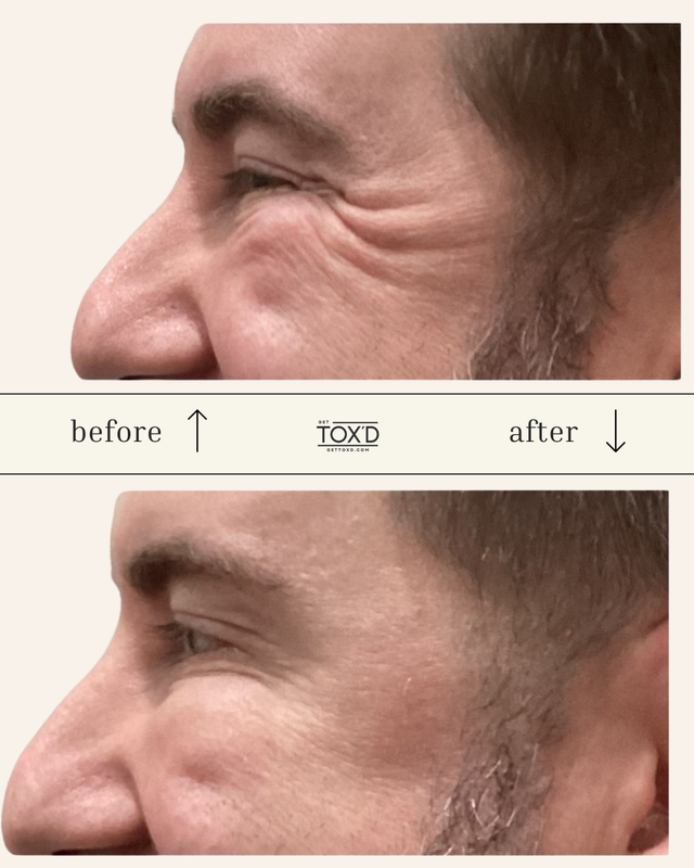 Brotox (Botox for men)