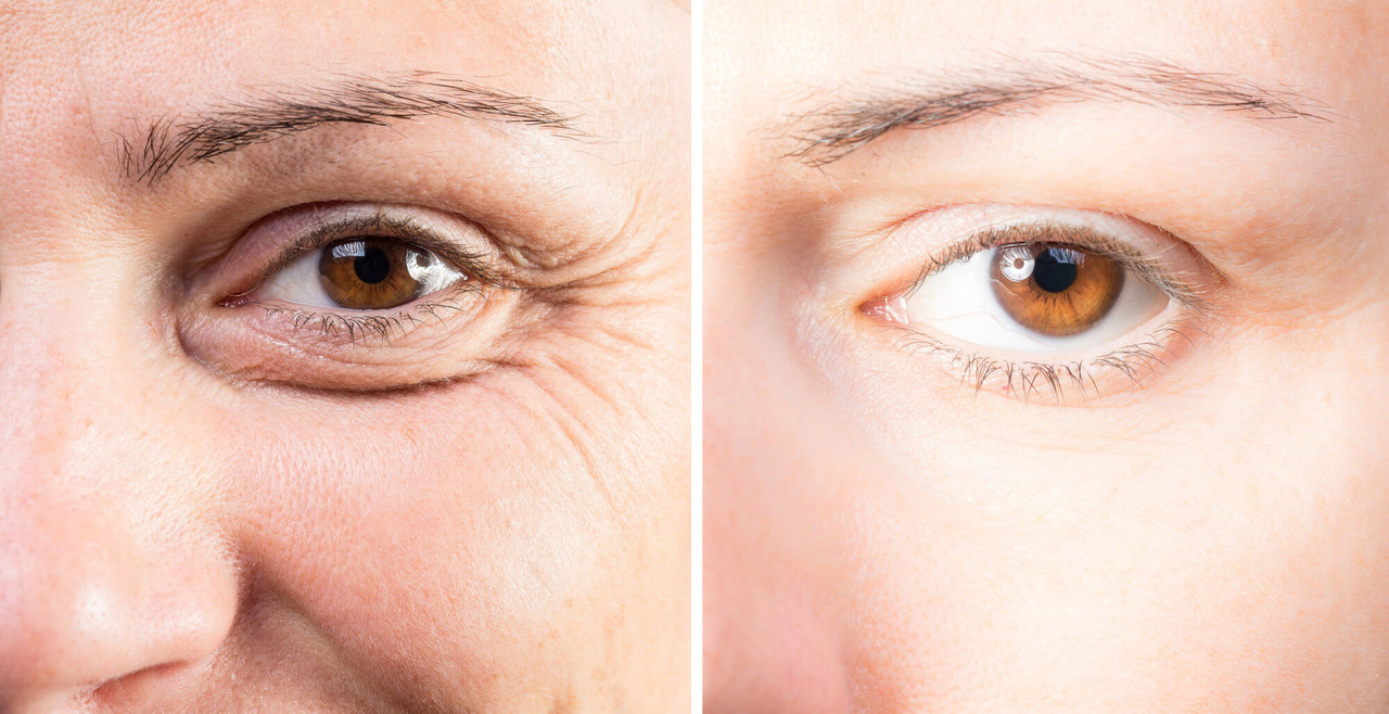 Blepharoplasty – Eye lid Surgery to improve Vision