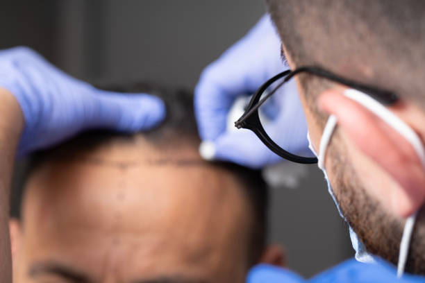 hair transplant Istanbul