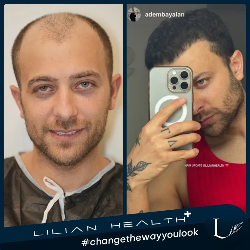 Mr. Bayalan before and after hair transplant result - 8500 grafts