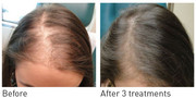 PRP hair treatment Before & After Female