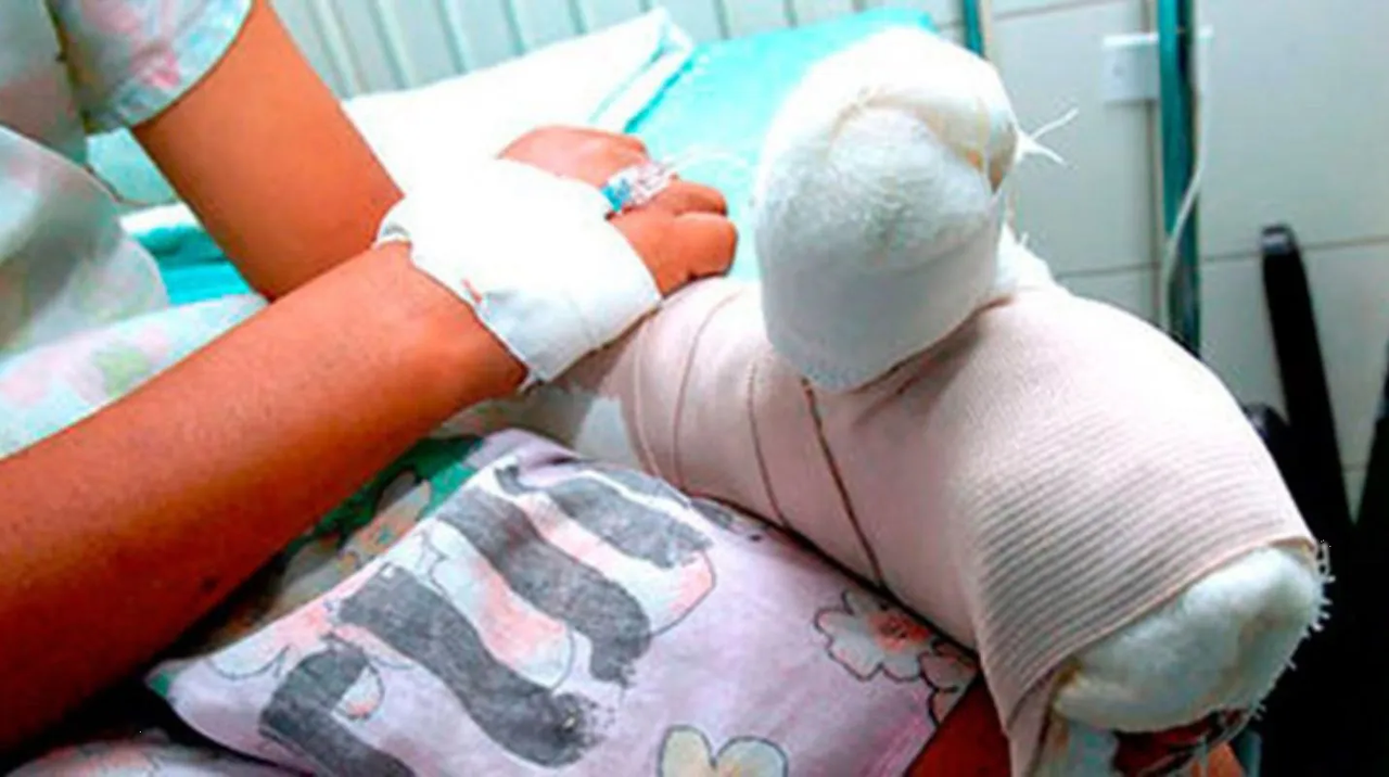 Padres queman a hija con aceite, la llevan al hospital tres días después