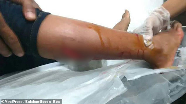 luka gigitan buaya di kaki kanan korban