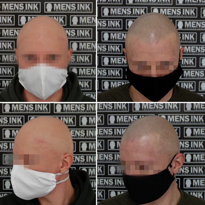 https://i.postimg.cc/Fz9d71x6/tricopigmentazione-alopecia-universale-1.jpg