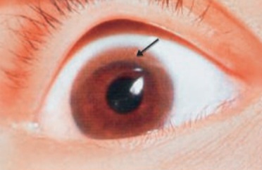 Slit-lamp photograph showing a golden-brown ring at the limbus of the cornea (Kayser-Fleischer ring), characteristic of Wilson disease