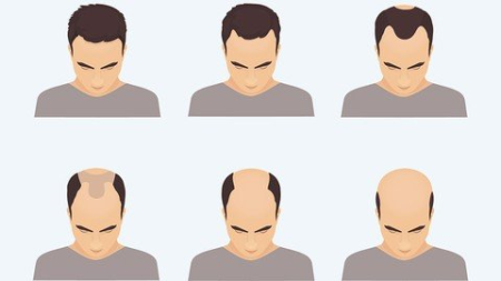 How to STOP male pattern hair loss & REGROW your own hair!