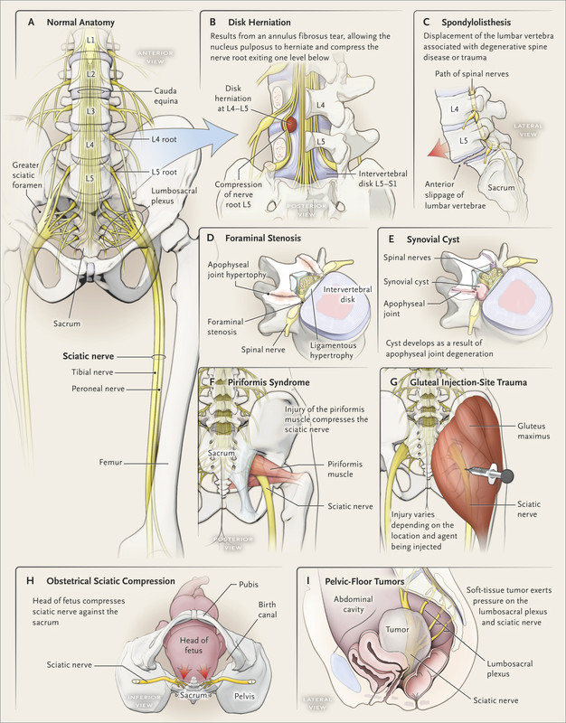 nejmra1410151-f1.jpg