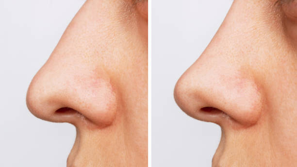 nose-jobs-6.jpg