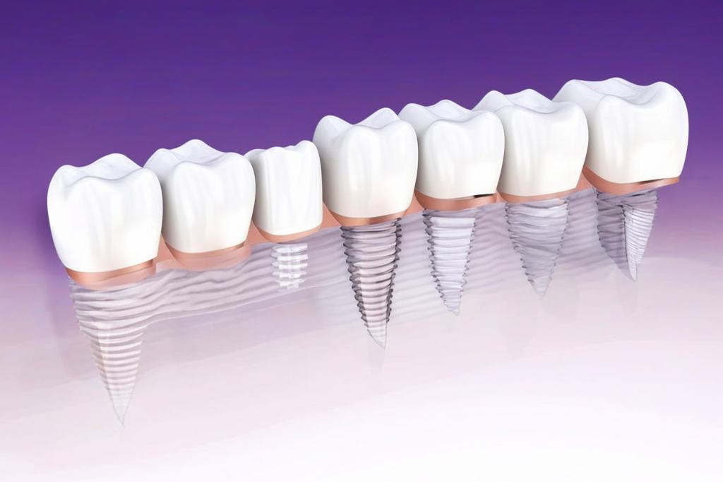 Зубные импланты