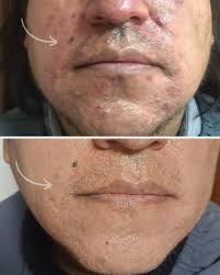 Antes y después rostro