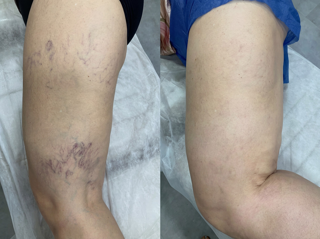 Resultado Variliss 1