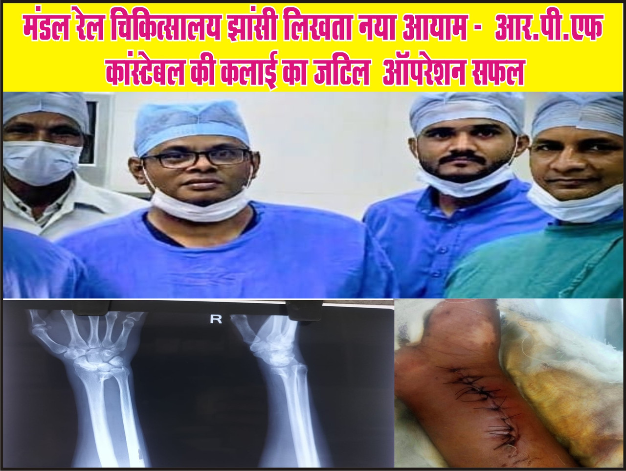 डल रेल चिकित्सालय झांसी लिखता नया आयाम - आर.पी.एफ कांस्टेबल की कलाई का जटिल ऑपरेशन सफल
