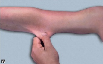 Clinical photograph demonstrating hyperextensible skin being pulled away from the neck in a child with Ehlers-Danlos syndrome