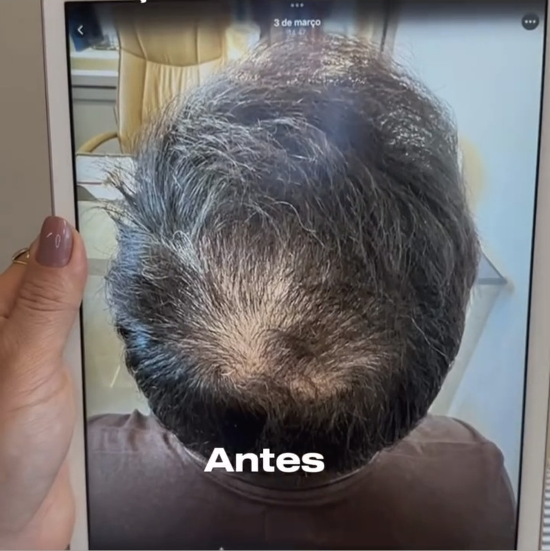 Antes e depois da terapia regenerativa 3