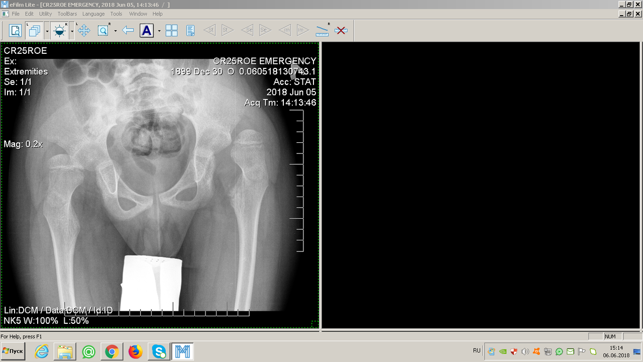 ренген июнь