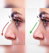 Nose Surgery Clinic