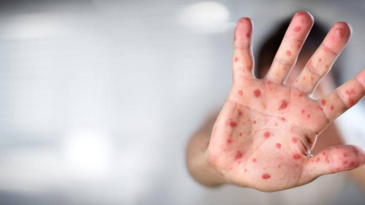 ¿Cuáles son los síntomas de la gripe del tomate?