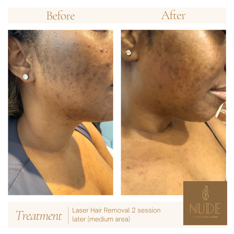 Laser Hair Removal Result