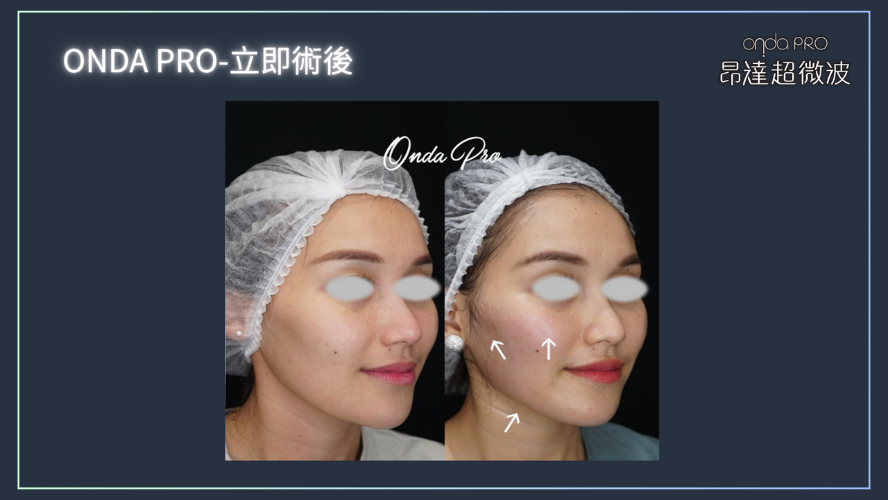 昂達超微波案例：立即效果