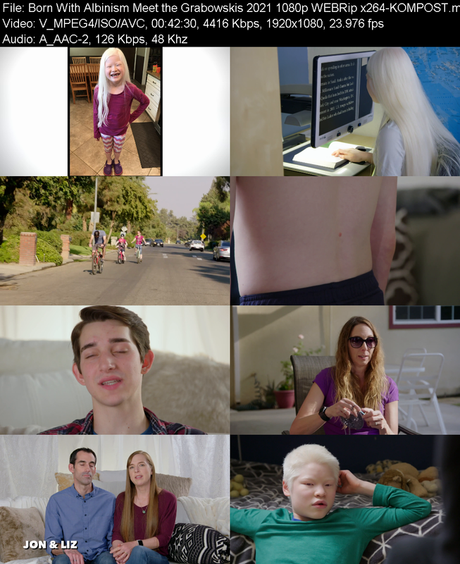 born-with-albinism-meet-the-grabowskis-2