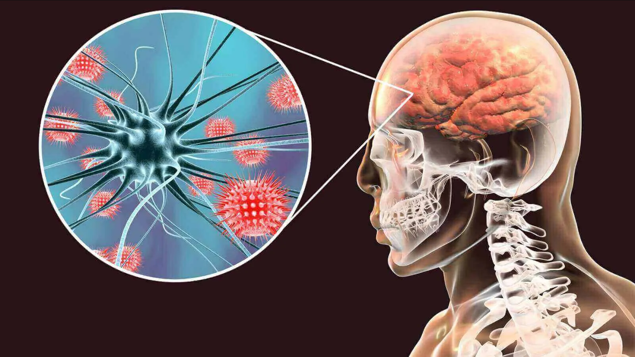 ¿Qué es la meningitis? Así puedes contagiarte