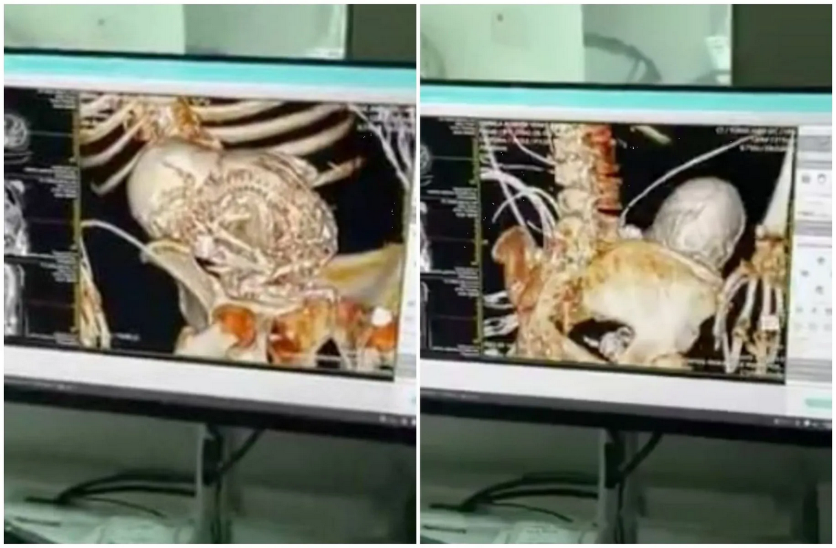 Mujer muere tras 30 años con un bebé calcificado en su vientre; intentaron quitárselo