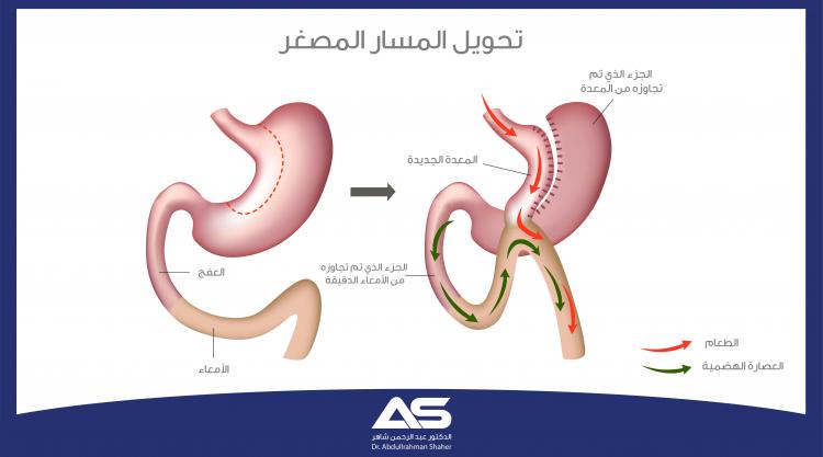 جراحة تحويل المسار المصغّرة Mini Gastric Bypass وصف العملية والتعافي بعد الجراحة
