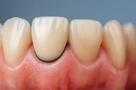 Dental crown margin examination