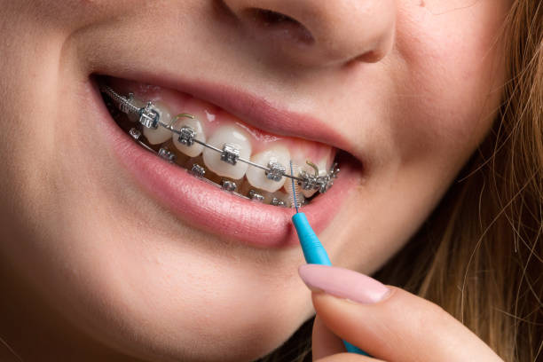 Braces for children in Lafayette CO