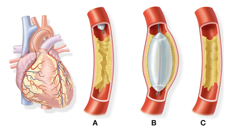 L'angioplastie | Fédération Française de Cardiologie