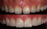 Diastema Closure