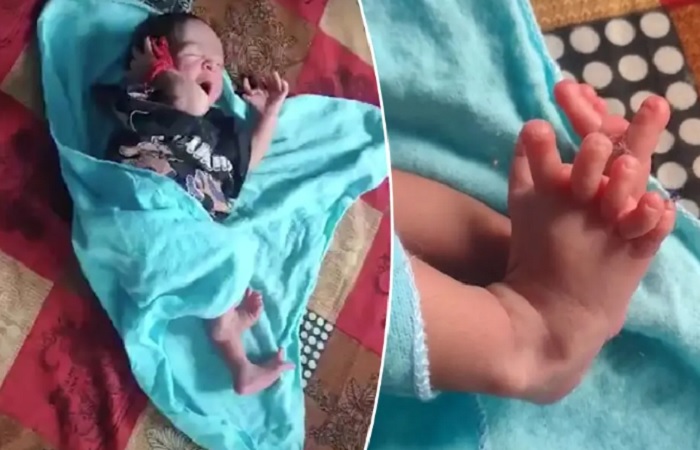 Seorang bayi yang lahir di India lahir dengan 26 jari tangan dan kaki, keluarganya menganggap sang bayi sebagai reinkarnasi dewi.