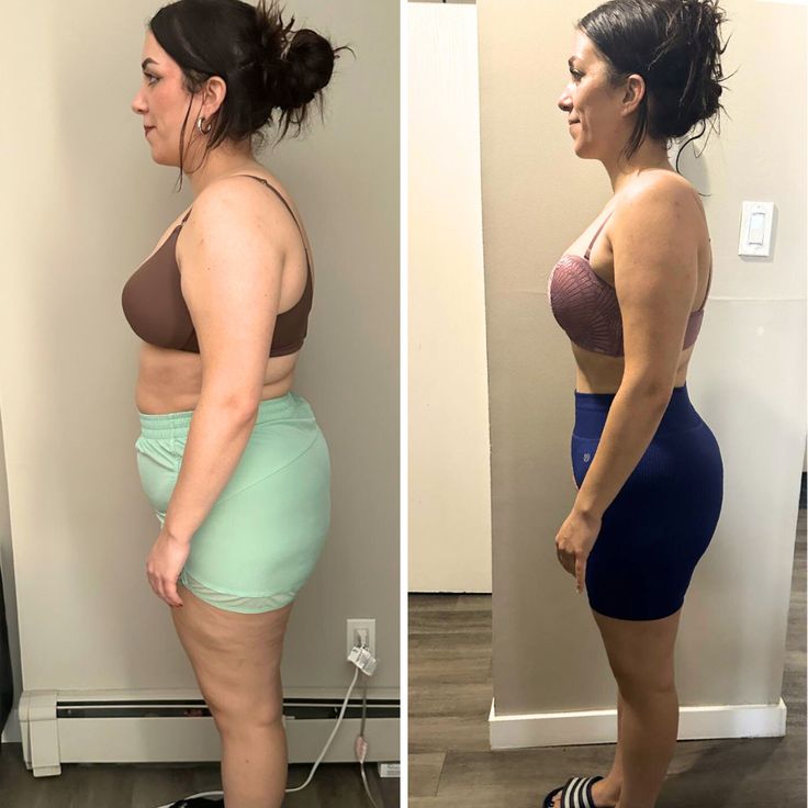 Antes y Después Desinflamada
