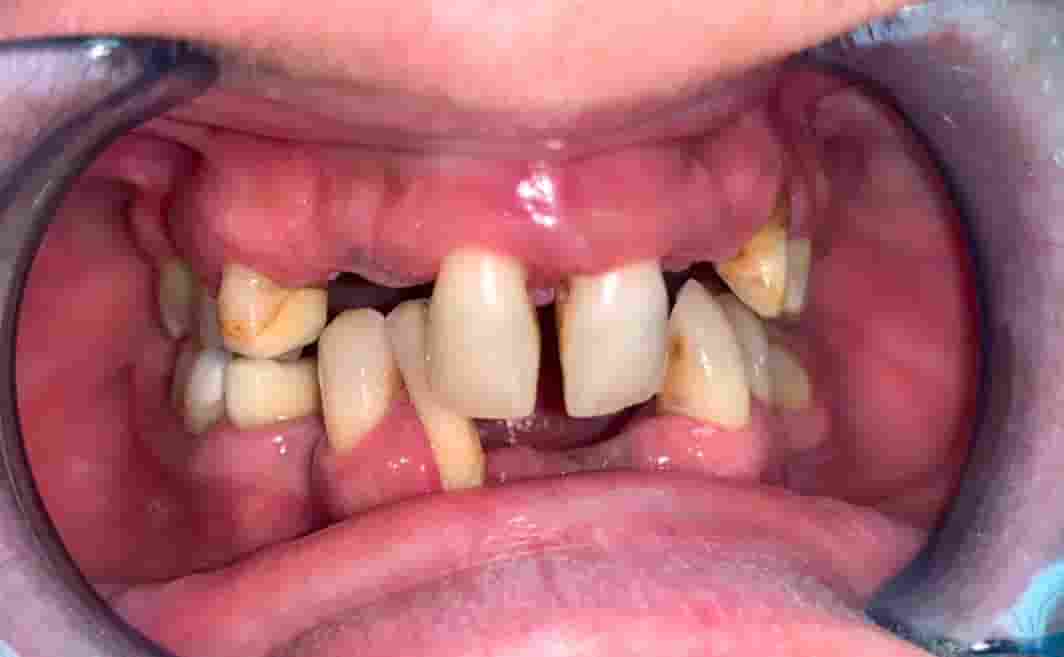 Prej – primer 2