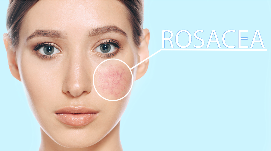 How to Get Rid of Rosacea Permanently