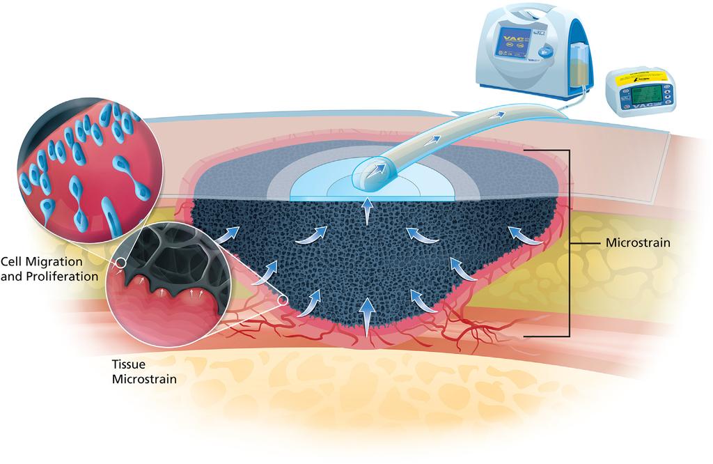 Negative Pressure Wound Therapy