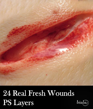 wounds