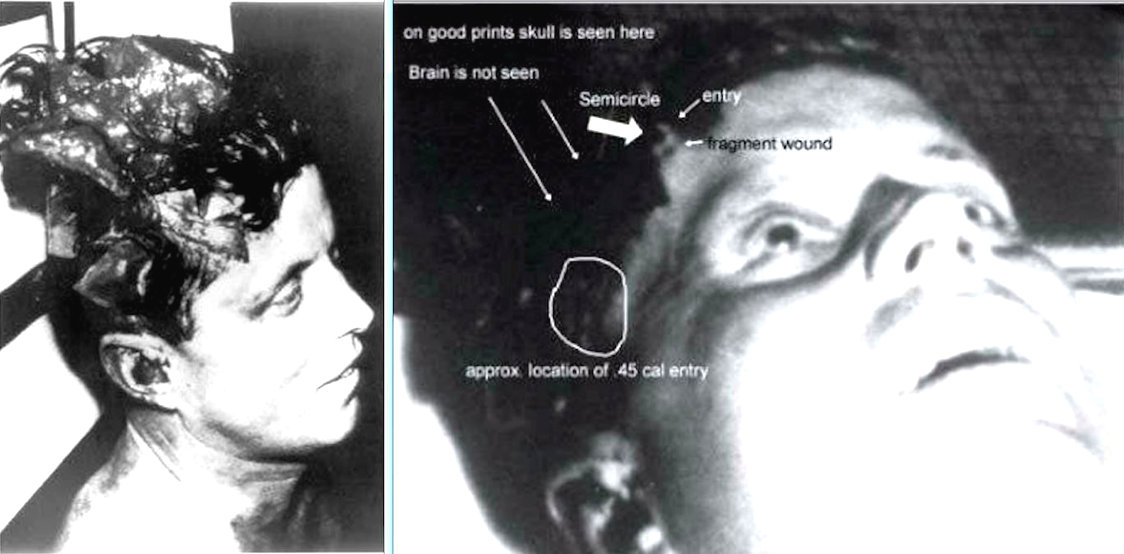 kennedy-head-wound-frontal.jpg