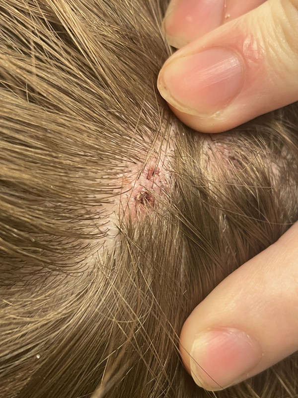 [28 M] Lymph nodes on one side of neck still painful and swollen from 2